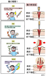 No.75 傷の種類1 | COLTマンガチャンネル