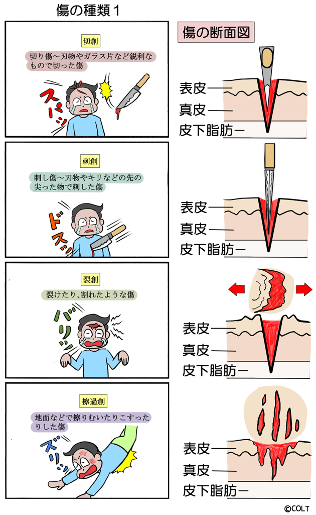 挫創と挫傷の違いざそう _ 擦過傷と挫創の違い _ 挫創について江戸川区・船堀の整形外科医が解説します。・筋挫傷とは・筋挫傷と肉離れはどう違う ...