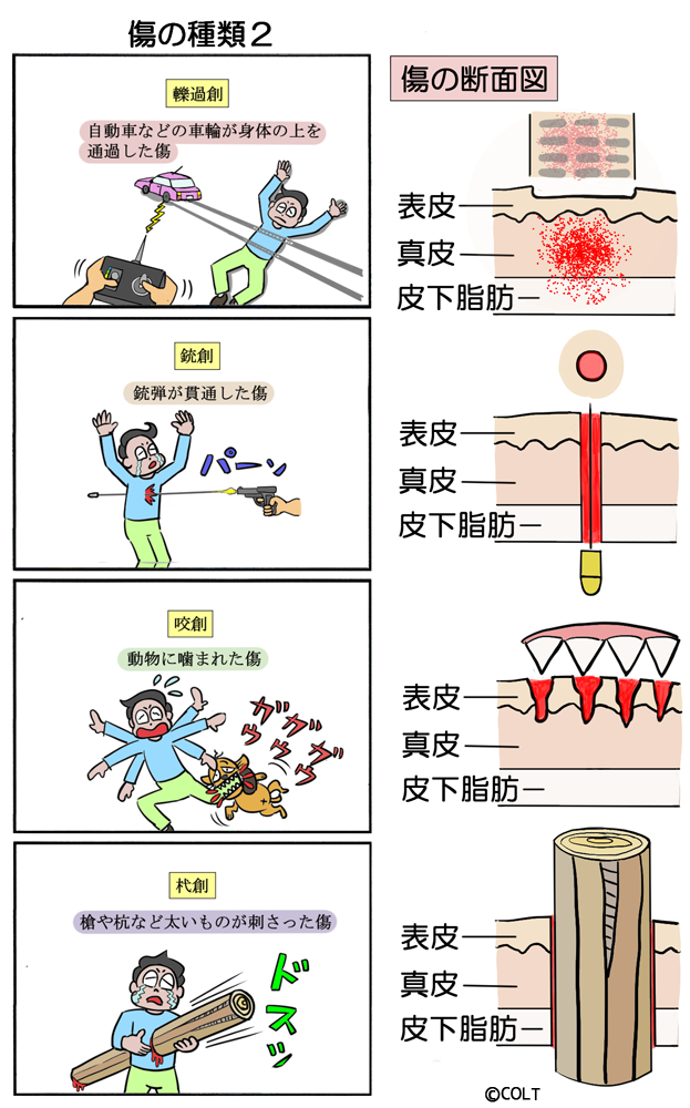 傷 ぐじゅぐじゅ, 傷 じゅくじゅく 医療用語 – CRXB